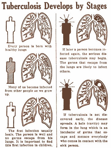 Healthy Weight Loss Approach -Medical Advisor Online: Tuberculosis – A Major Threat To Public Health | uxa2.com